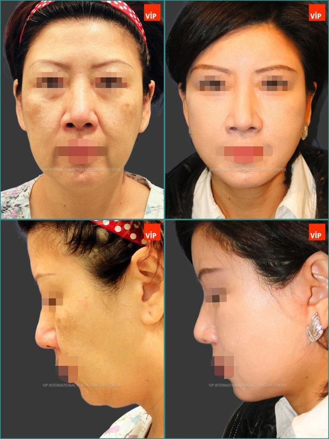 Anti aging surgeries combination