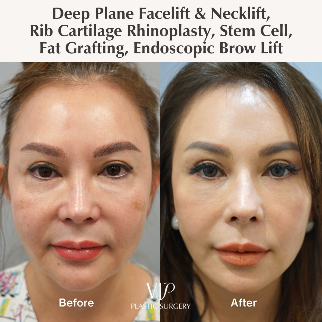 Before and after facelift and rhinoplasty - front view