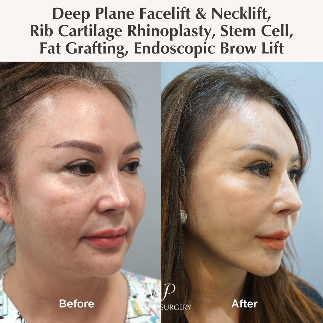 Before and after facelift and rhinoplasty - oblique view