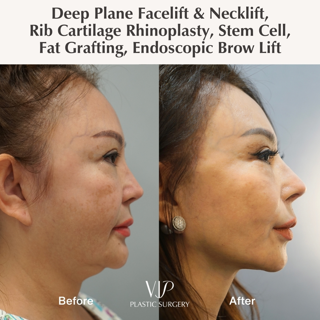 Before and after facelift and rhinoplasty - side view