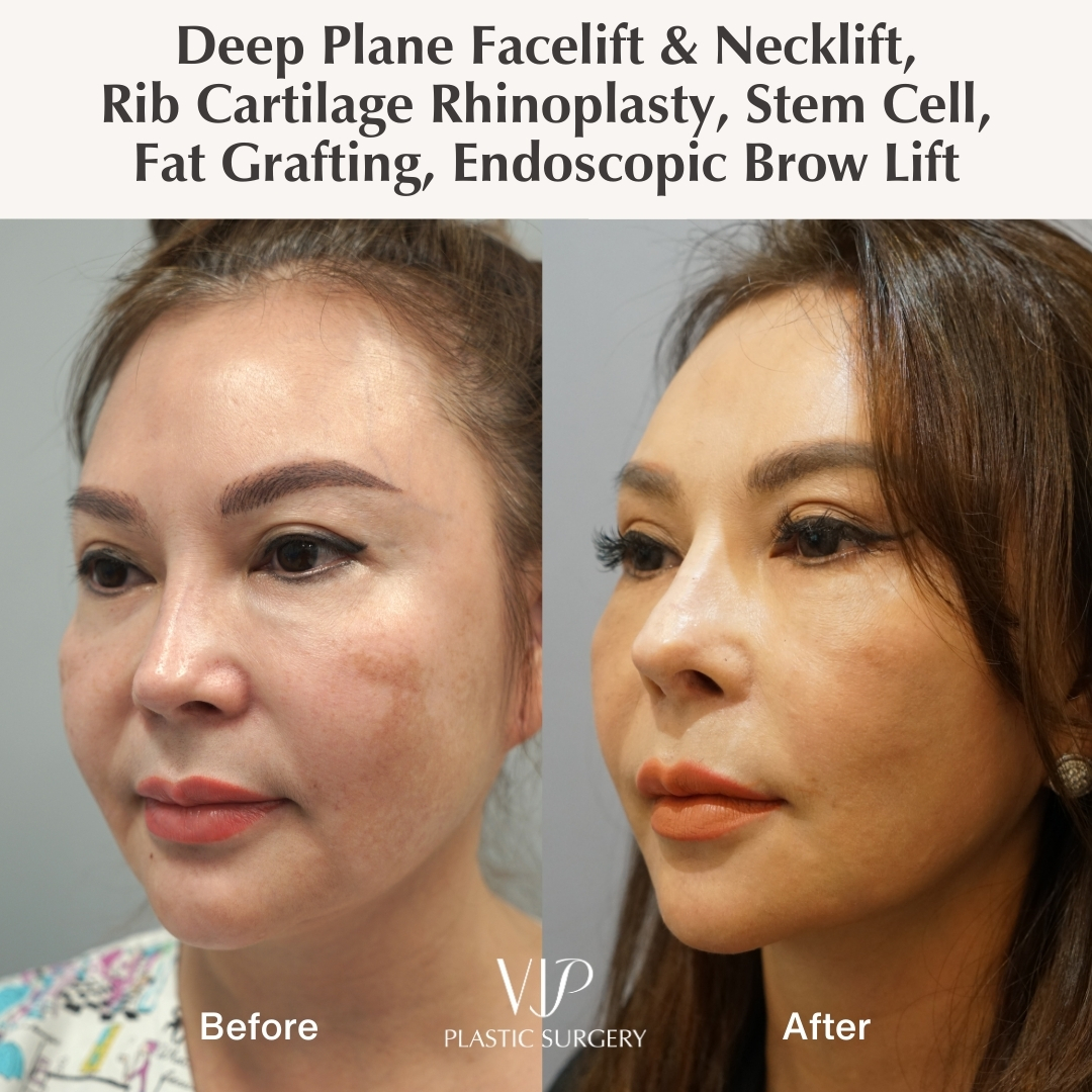 Before and after facelift and rhinoplasty - oblique view