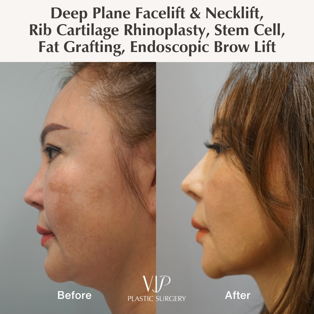 Before and after facelift and rhinoplasty - side view