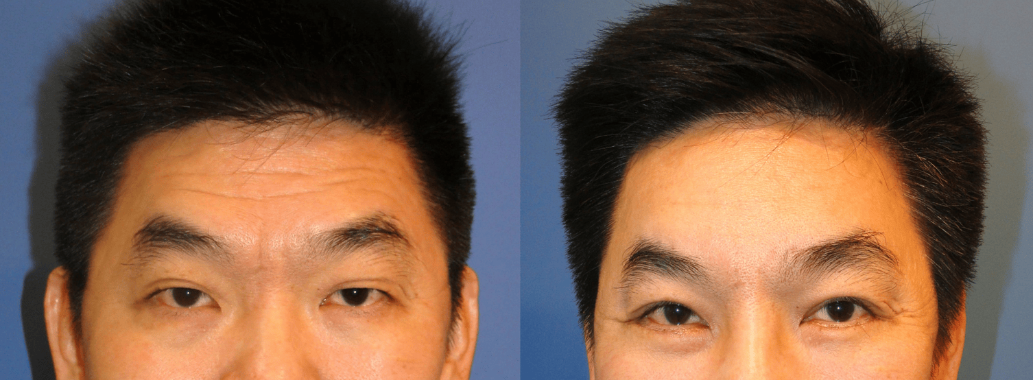 Forehead endoscope surgery & Upper blepharoplasty photo