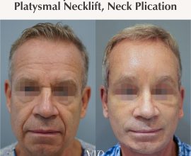 Deep Plane Facelift, Necklift, Middle Neck Plication, Endoscopic Forehead Brow Lift