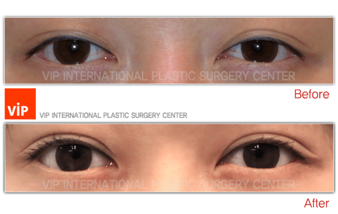 Eyelid surgery, Double Fold - Non incision double eyelid photo