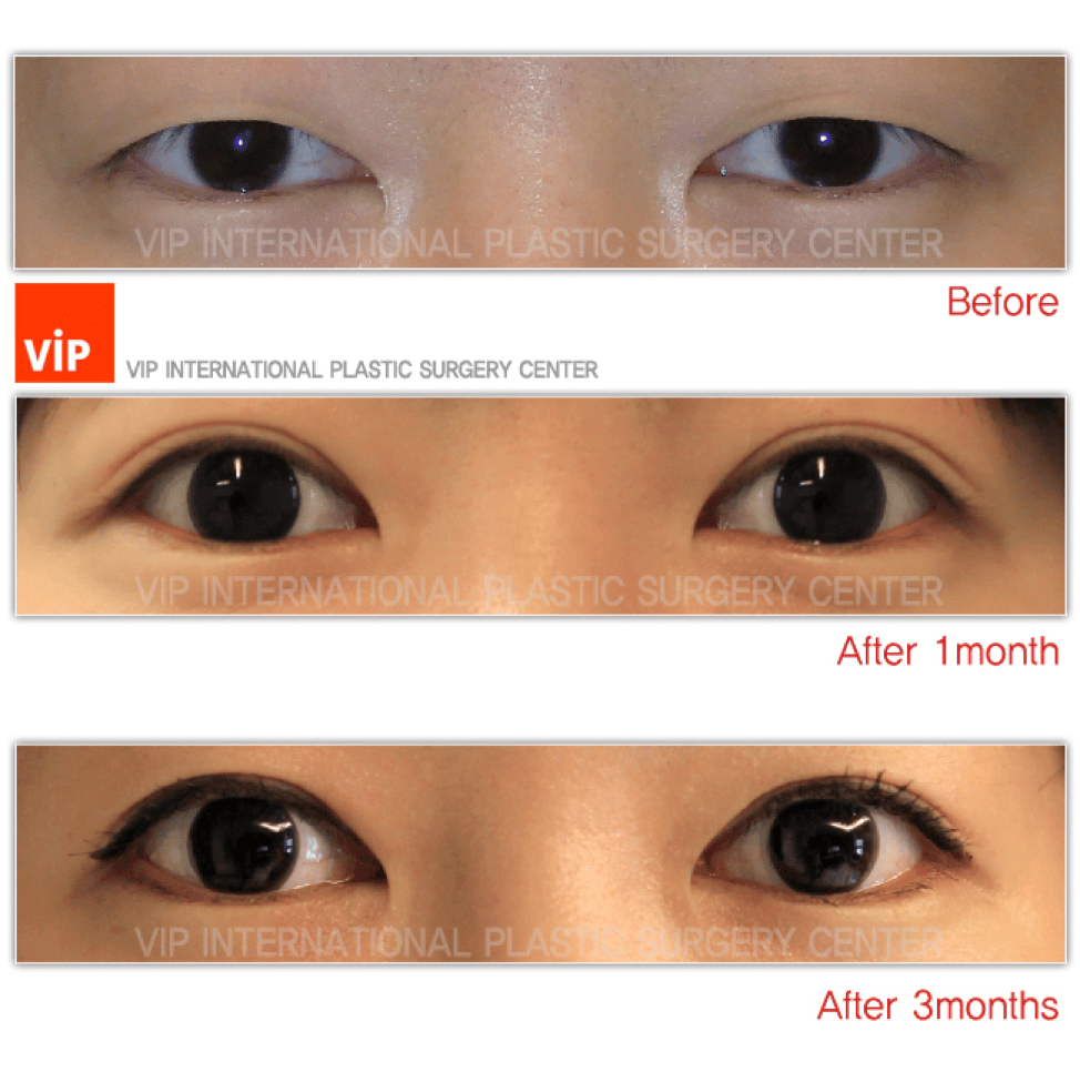 Ptosis correction before & after photo