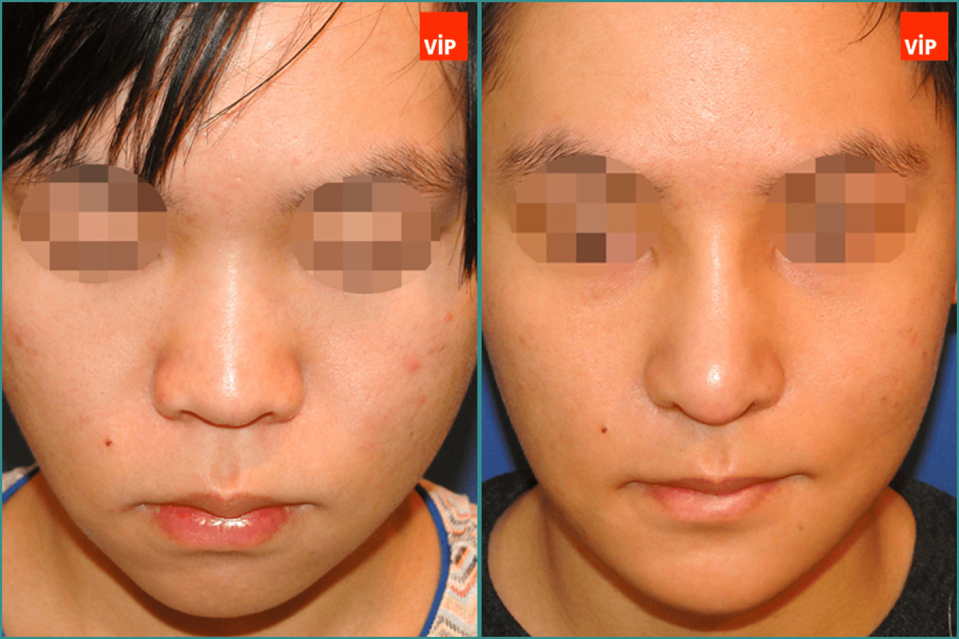 Rhinoplasty, Genioplasty before after photo front line