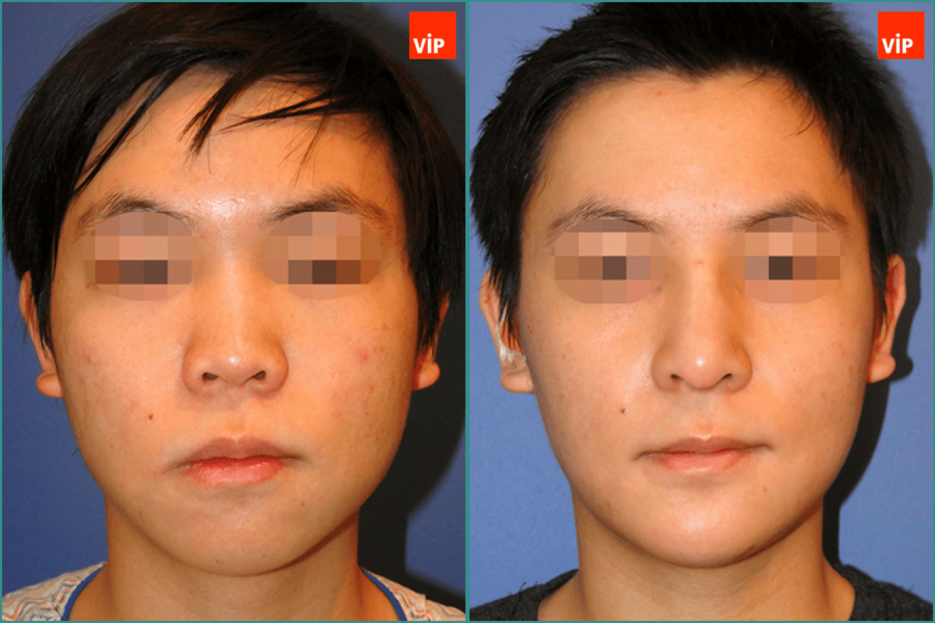 Rhinoplasty, Genioplasty before after photo