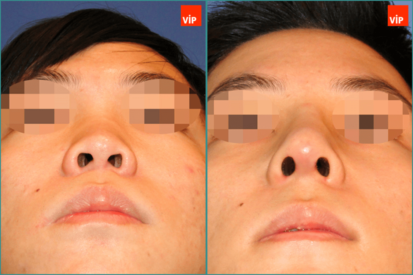 Rhinoplasty, Genioplasty before after photo 2