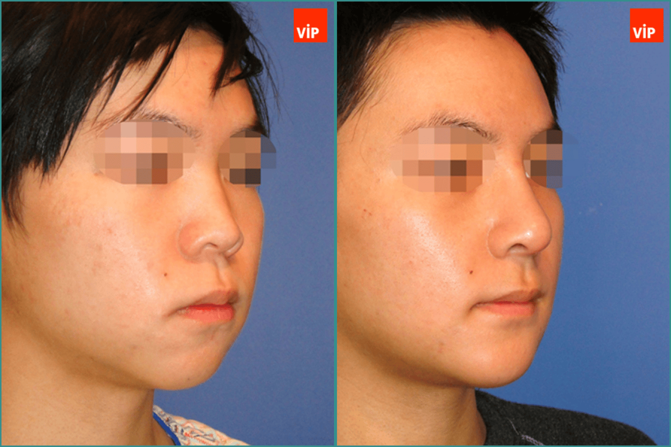 Rhinoplasty, Genioplasty before after photo right side