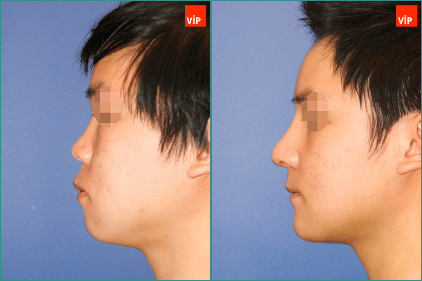 Rhinoplasty, Genioplasty before after photo left