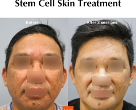 Stem Cell Skin Treatment